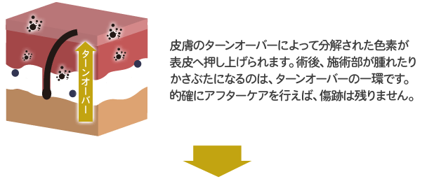 フェニックスLite V2図解2